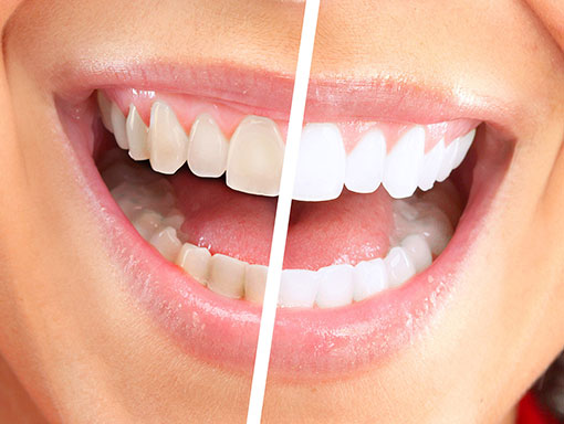 5 Tips To Prevent Stained Teeth