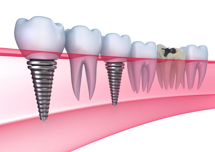 Dental Implants: Built to Last and Look Beautiful