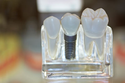 Implant Supported Dentistry Provides Numerous Options for Tooth Replacement