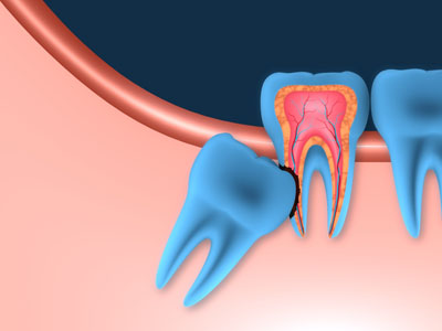 Wisdom tooth extractions: It’s not as bad as one might think